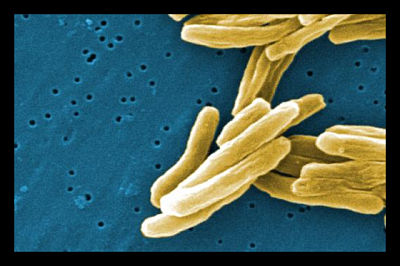  tuberculosis