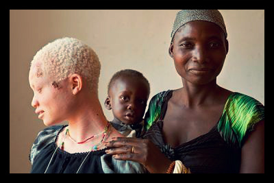 Albino_Africa_Tanzania