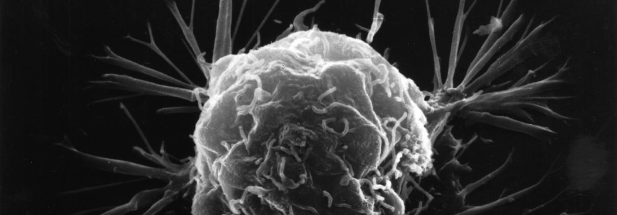 Cancer Screening in Uganda