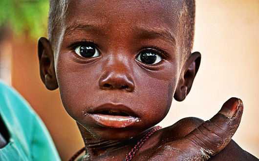 Facts About Malnutrition