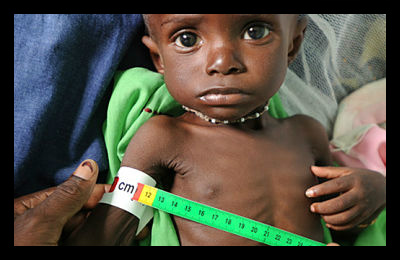 Malnutrition_Mozambique