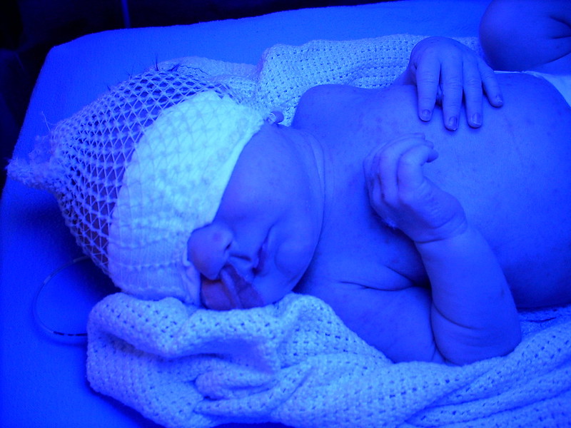 phototherapy for jaundice babies