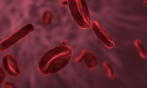 sickle cell disease in Tanzania