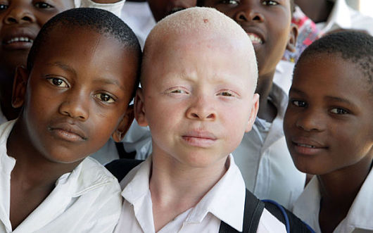 Partial Albinism In Humans