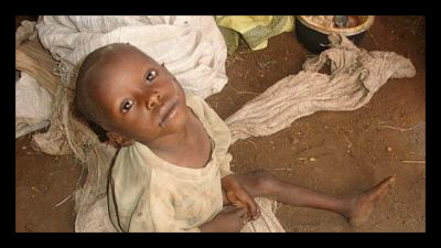 malnutrition_in_liberia